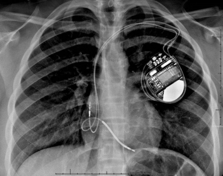 Critical Pacemaker Vulnerability Revealed – Millions of Lives at Risk